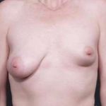 Breast Asymmetry Before & After Patient #1220