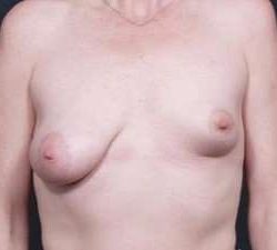 Breast Asymmetry Before & After Patient #1220