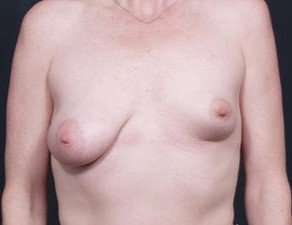 Breast Asymmetry Before & After Patient #1220