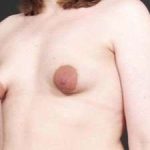 Breast Asymmetry Before & After Patient #1225