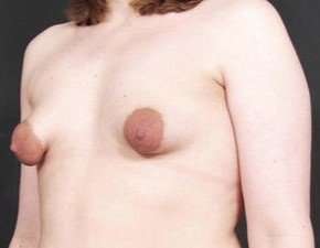 Breast Asymmetry Before & After Patient #1225