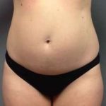 Tummy Tuck Before & After Patient #1228
