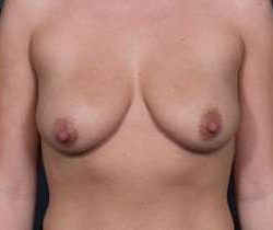 Breast Mastopexy Before & After Patient #176