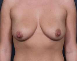 Breast Mastopexy Before & After Patient #176