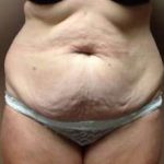 Tummy Tuck Before & After Patient #1233