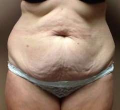 Tummy Tuck Before & After Patient #1233