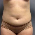 Tummy Tuck Before & After Patient #1238