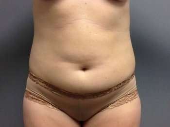 Tummy Tuck Before & After Patient #1238