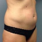 Tummy Tuck Before & After Patient #1243