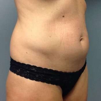 Tummy Tuck Before & After Patient #1243