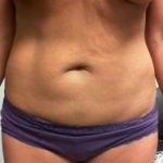 Tummy Tuck Before & After Patient #1246