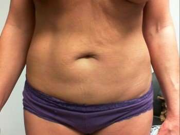 Tummy Tuck Before & After Patient #1246