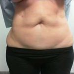 Tummy Tuck Before & After Patient #1251