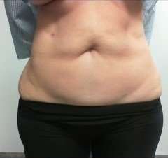 Tummy Tuck Before & After Patient #1251