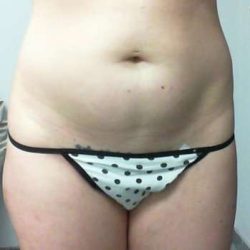 Tummy Tuck Before & After Patient #1256