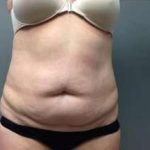 Tummy Tuck Before & After Patient #1263
