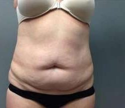 Tummy Tuck Before & After Patient #1263