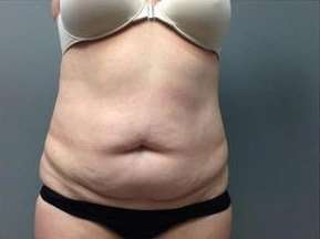 Tummy Tuck Before & After Patient #1263