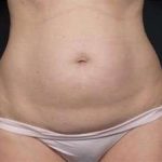 Tummy Tuck Before & After Patient #1270