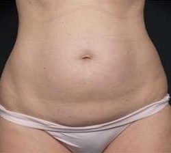 Tummy Tuck Before & After Patient #1270
