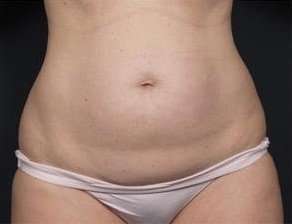 Tummy Tuck Before & After Patient #1270
