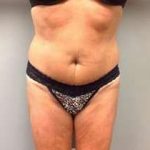 Tummy Tuck Before & After Patient #1277