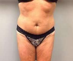 Tummy Tuck Before & After Patient #1277