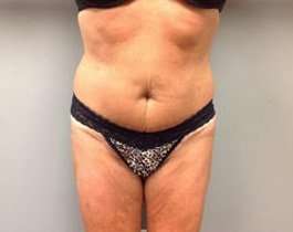 Tummy Tuck Before & After Patient #1277