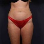 Tummy Tuck Before & After Patient #1284
