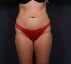 Tummy Tuck Before & After Patient #1284