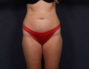 Tummy Tuck Before & After Patient #1284