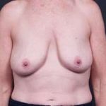 Breast Mastopexy Before & After Patient #183