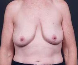 Breast Mastopexy Before & After Patient #183