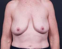 Breast Mastopexy Before & After Patient #183