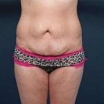 Tummy Tuck Before & After Patient #1289