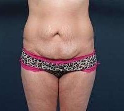 Tummy Tuck Before & After Patient #1289