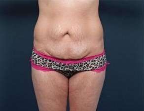 Tummy Tuck Before & After Patient #1289