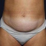 Tummy Tuck Before & After Patient #1296
