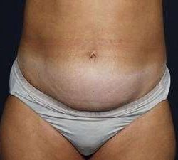 Tummy Tuck Before & After Patient #1296