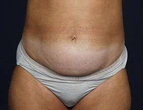 Tummy Tuck Before & After Patient #1296