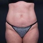 Tummy Tuck Before & After Patient #1303