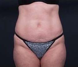 Tummy Tuck Before & After Patient #1303