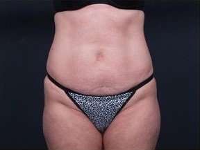 Tummy Tuck Before & After Patient #1303