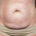 Tummy Tuck Before & After Patient #1310