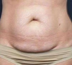 Tummy Tuck Before & After Patient #1310