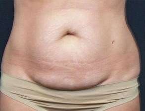 Tummy Tuck Before & After Patient #1310
