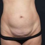 Tummy Tuck Before & After Patient #1315