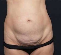 Tummy Tuck Before & After Patient #1315