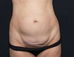 Tummy Tuck Before & After Patient #1315