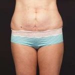 Tummy Tuck Before & After Patient #1322